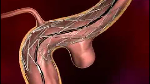 Endovascular Embolization or Coiling