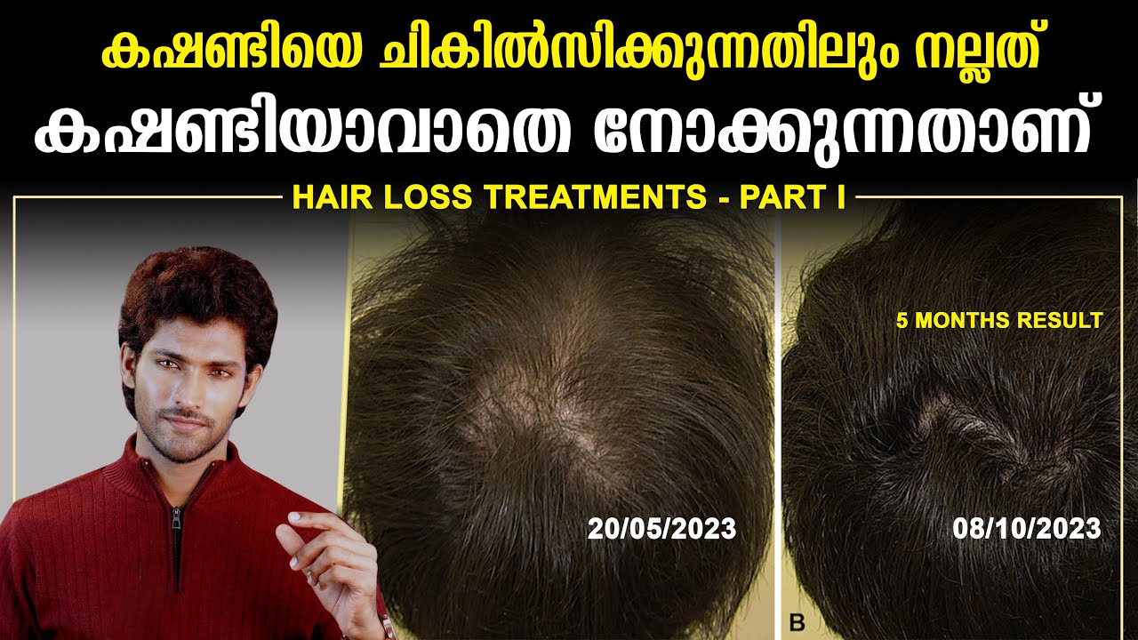 കൃത്യസമയത്ത് ചികിൽസിച്ചാൽ കഷണ്ടിയാവാതെ രക്ഷപെടാം | Hair fall Treatments Part 1 | Malayalam