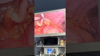 Laparoscopic Appendectomy | Educational Surgical Video | General Surgery Procedure