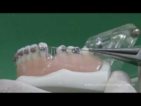 Arco Segmentado para Retrao do Dente Canino