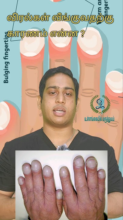 What Is Nail Clubbing Finger Clubbing what-is-nail-clubbing-finger-clubbing