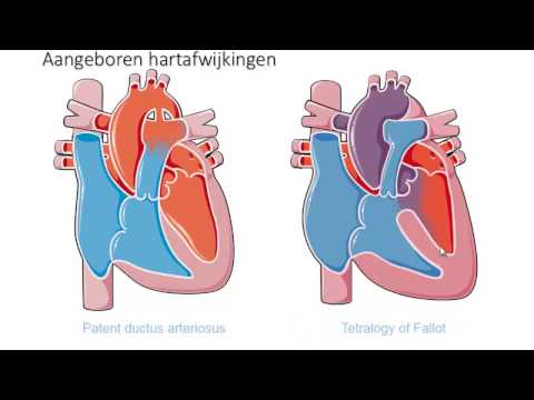 hart deel 5 aangeboren hartafwijkingen