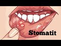 STOMATIT NEGA CHIQADI?   СТОМАТИТ НЕГА ЧИКАДИ?