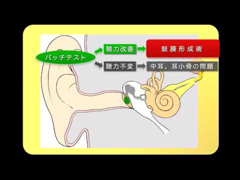 単純鼓膜穿孔