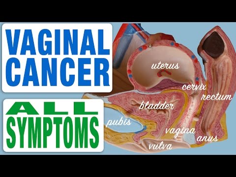 Vaginal Cancer - All Symptoms