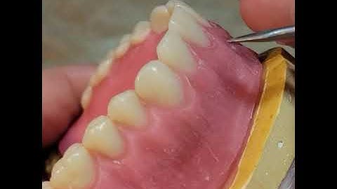 Maxillary Denture Wax up