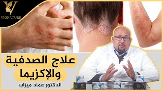 كيف تتخلص من من الإكزيما والصدفية بشكل طبيعي مع الدكتور عماد مزاب​