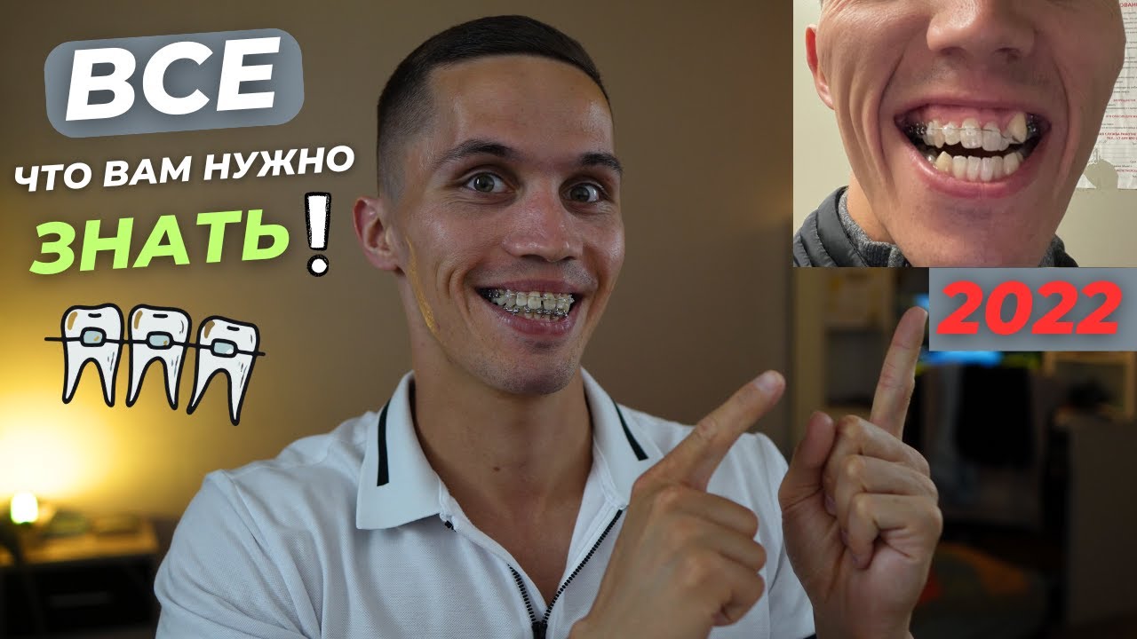 ВСЕ что нужно знать про БРЕКЕТЫ. Ортогнатическая операция. Стоимость, квота. Подробная инструкция