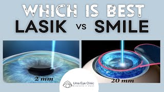 Laser Eye Surgery: Lasik vs Smile | Dr ArulMozhi Varman | Uma Eye Clinic