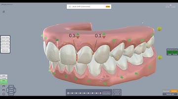 ArchForm Tutorial - How to Plan IPR in the Treatment Planning Software
