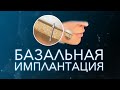 Базальная имплантация зубов.