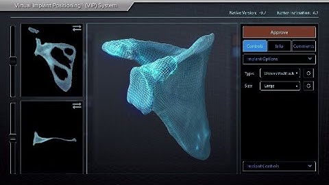 Virtual Implant Positioning™ (VIP) System