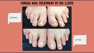 Treatment of Fungal Nails with Laser (Before and After Shown)!