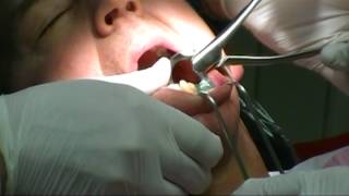 Physics Forceps - Extraction Tooth #20 Mandibular Left 2nd Premolar