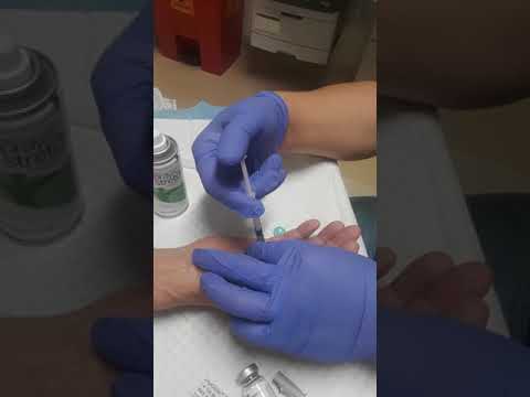 Dupretreans Contractors Injections 2018 by Hand Surgeon @ Kaiser Permanente in Modesto Ca