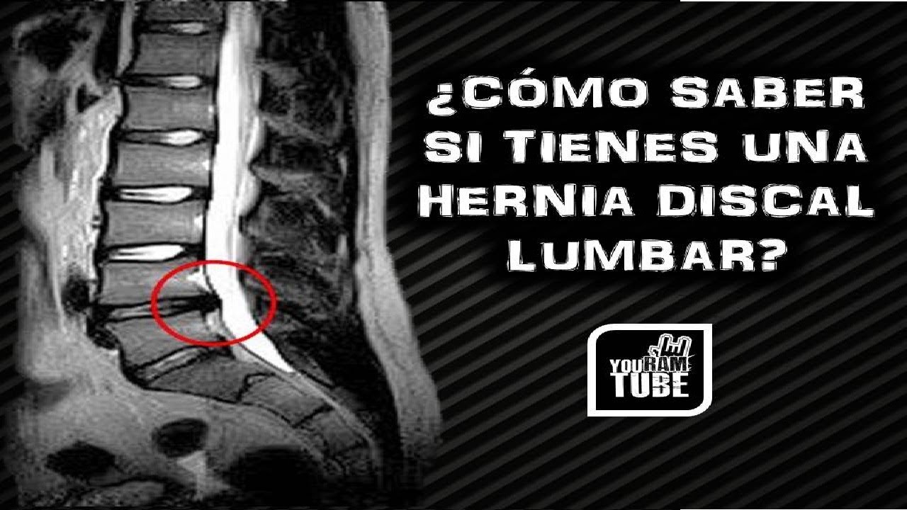 COMO SABER SI TIENES UNA HERNIA DISCAL LUMBAR / SIGNOS Y DIAGNOSTICO DE