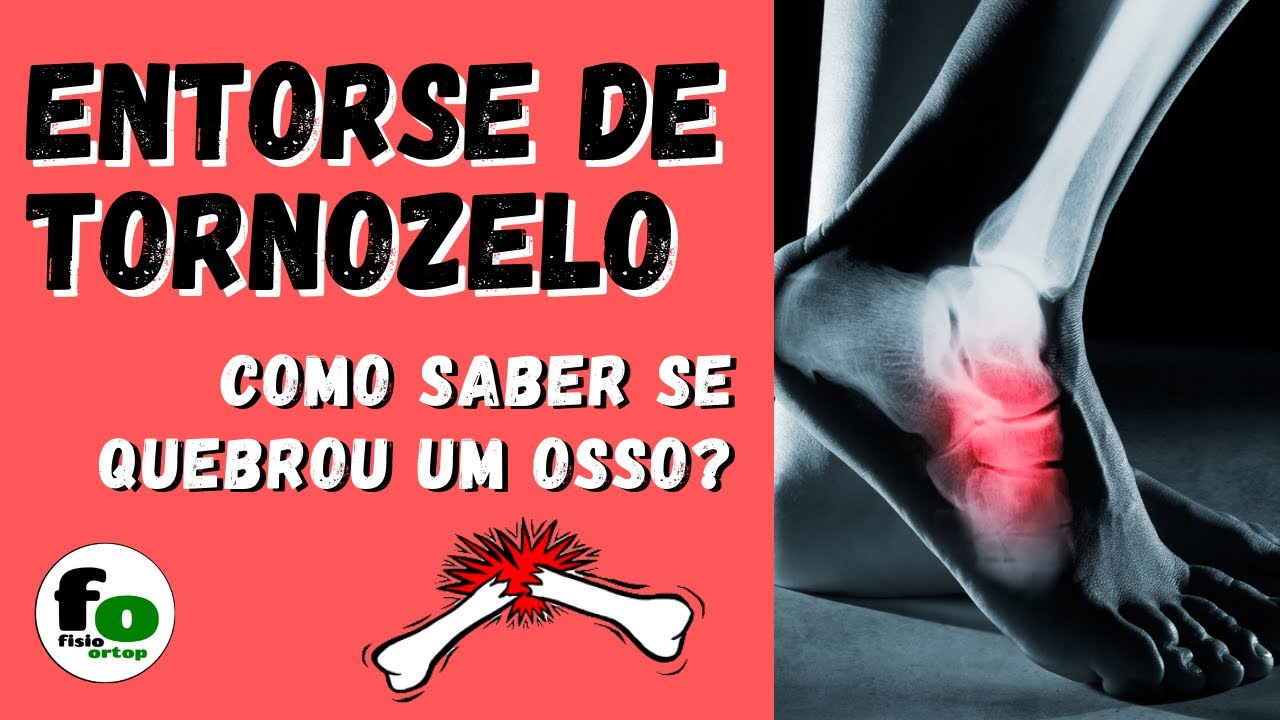 Entorse de tornozelo: preciso fazer RX? | Regras de Ottawa