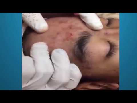 Cystic Acne, Terrible Pimples And Blackheads Extraction Acne Treatment On Face DISGUSTING VIDEOS HD