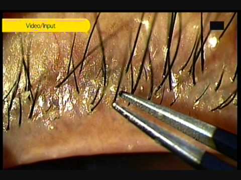 Demodex (Hair Follicle Mite) Types, Symptoms and Treatment