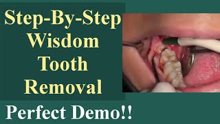 Extraction Procedure Of Horizontal Impacted Right 3rd Molar Tooth🦷|Step-By-Step Wisdom Tooth Removal