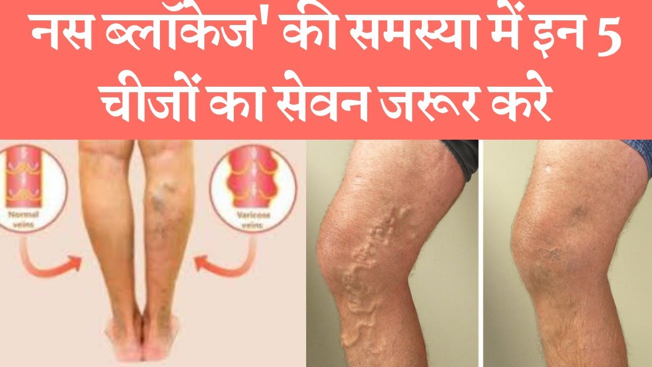 Take these things in the problem of vein blockage नस ब्लॉकेज' की समस्या में इन चीज़ो का सेवन करे dark secrets midsomer murders
