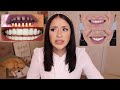 All About My Mexican Veneers | HOW MUCH DID I PAY? Are They Worth It?