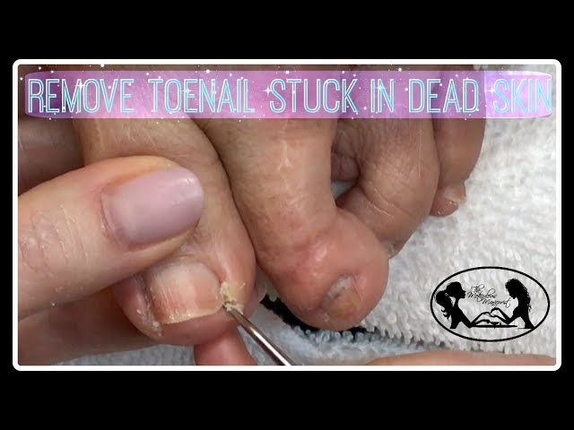 Thick Toenails: Diagnosis, Pictures, Causes, and Treatments