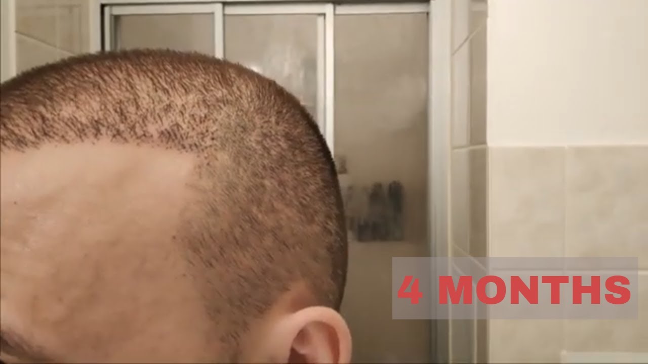 Hair Transplant Results 4 Months, FUE Turkey YouTube