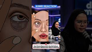 #asmr Eye Stone Removal &amp; Eyelid Sebum Extrusion Meibomian Gland Cleaning #animation #beauty