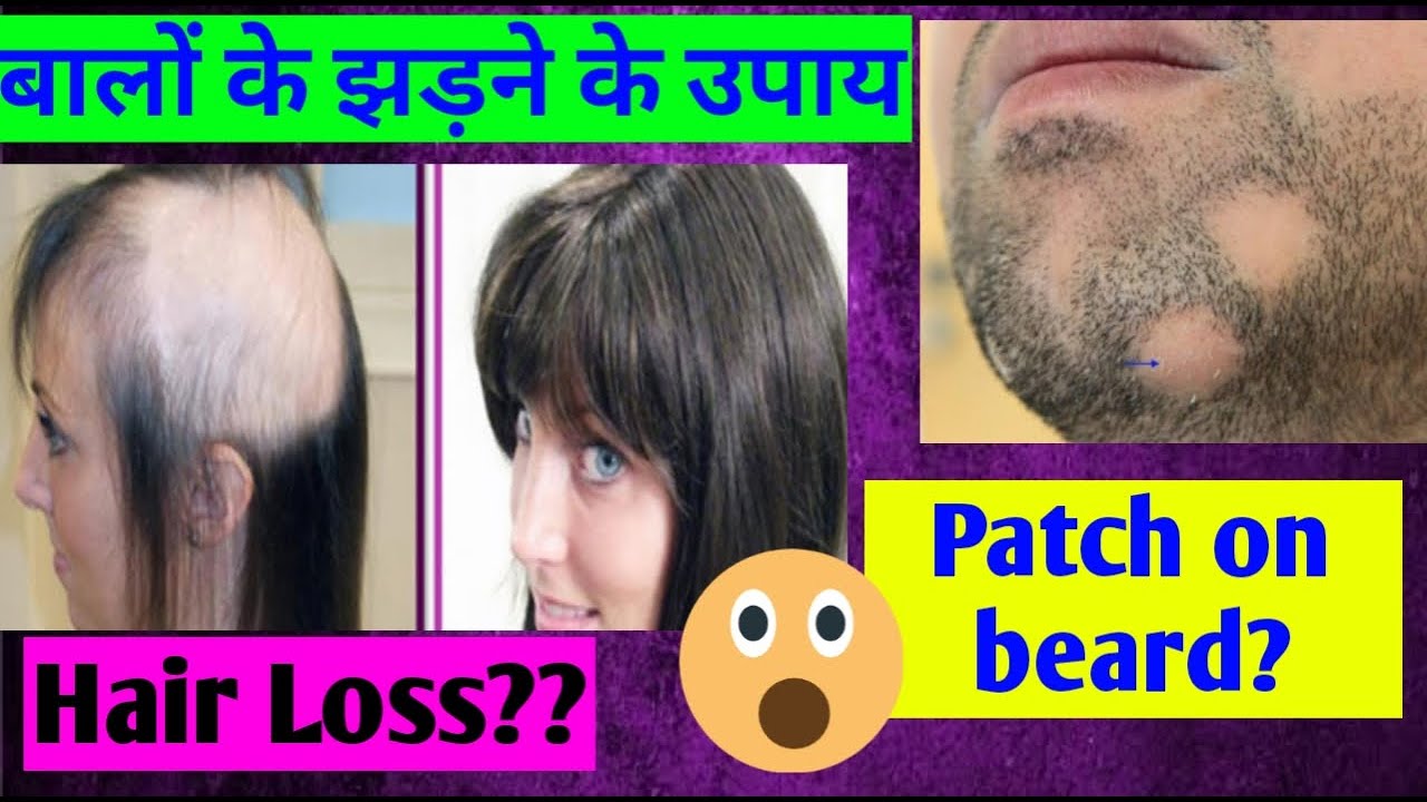 Best Hair Loss Remedies Ayurvedic बालों के झड़ने के उपाय Hair