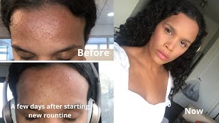 Hi everyone!today i am excited to share how got rid of the small
forehead bumps that had for months. will be showing you cleared tiny
o...