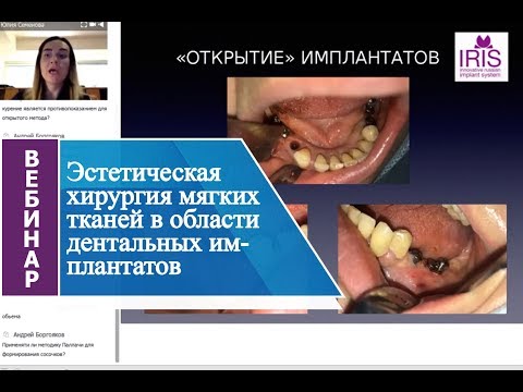 Вебинар "Эстетическая хирургия мягких тканей в области дентальных имплантатов"