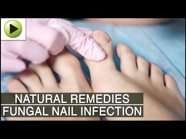 Ayurvedic Remedies for nail problems and nail care