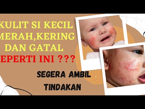 Dermatitis Atopik / Eksim pada bayi dan anak || SEBAB dan CARA mengatasinya