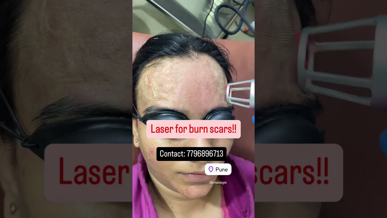 #shorts Laser Treatment for Burn Scars | Dr. Rashmi Aderao Skin and Hair Clinic
