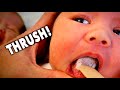 MY TWIN BABIES HAVE THRUSH!!! (Help) | Dr. Paul