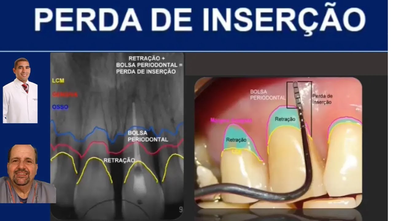 Porque Essa Perda Extra De Massa é Temporária