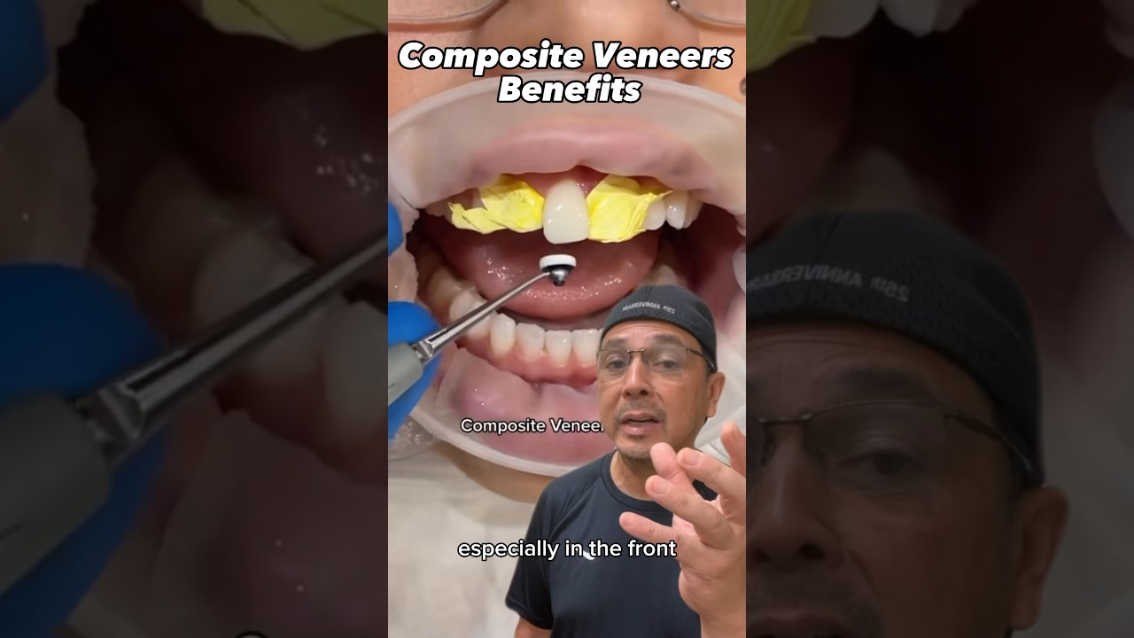 Объяснение процесса крепления композитных виниров | Практические занятия в стоматологическом каби...