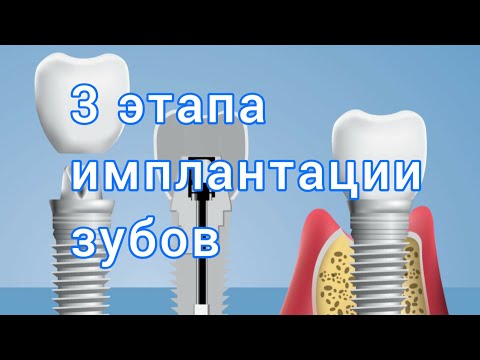 Что входит в ИМПЛАНТАЦИЮ зуба? ЭТАПЫ имплантации зубов.