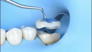 OVERLAY DELIVERY WITH WARM COMPOSITE