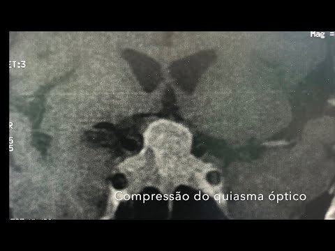 Hipofisectomia transesfenoidal - macroadenoma de hipófise.