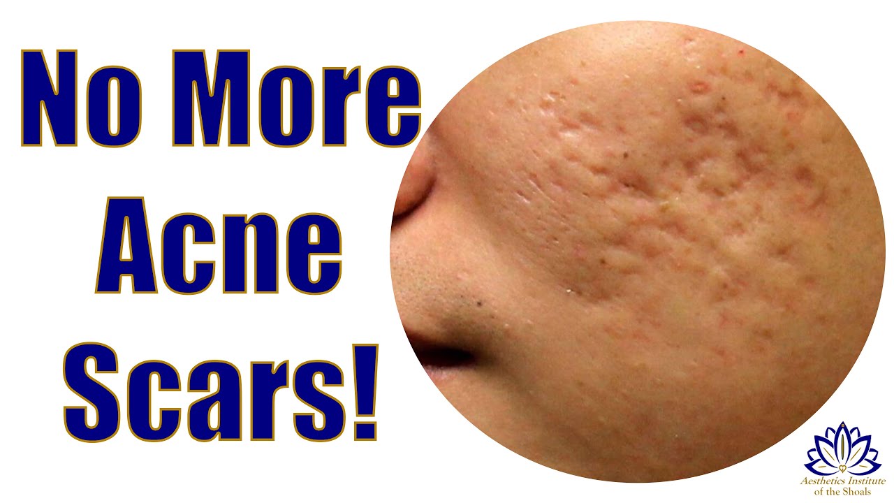 I Wish There Was A Way To Get Rid Of My Acne Scars YouTube i-wish-there-was-a-way-to-get-rid-of-my-acne-scars-youtube
