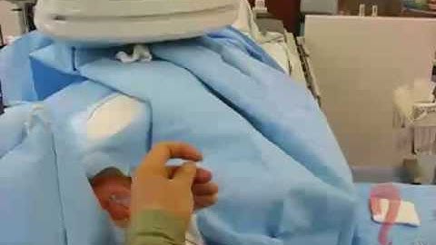 Coil embolization of ovarian veins