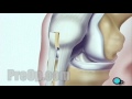 Patient Education Anterior Cruciate Ligament Arthroscopic Repair Surgery