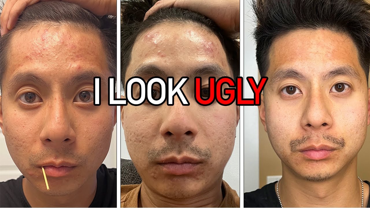 I Cleared My Acne with ONLY 2 Products! - YouTube