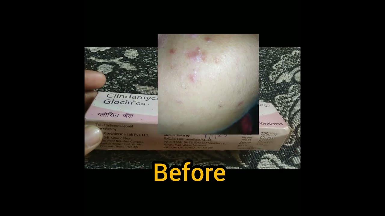 cinematic & Nicotinamide gel glocin gel use before and after.....💓💓💓💓