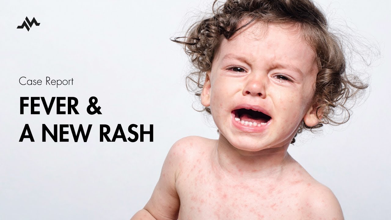 Pediatric Fever and Rash - Case Report