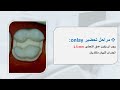 الحشوات المصبوبة Inlay Onlay 
