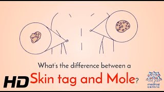 Decoding Skin Bumps Mole Vs. Skin Tag - Know The Difference