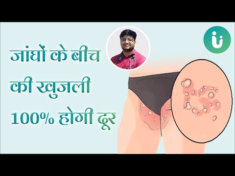 वीडियो: खुजली वाली खुजली को कैसे रोकें: 11 कदम (चित्रों के साथ)